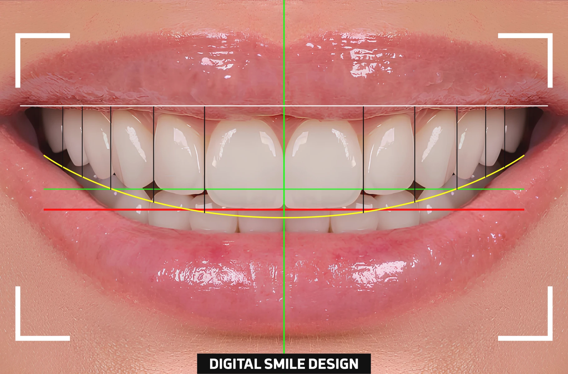 Analyse numérique d'un sourire avant traitement esthétique