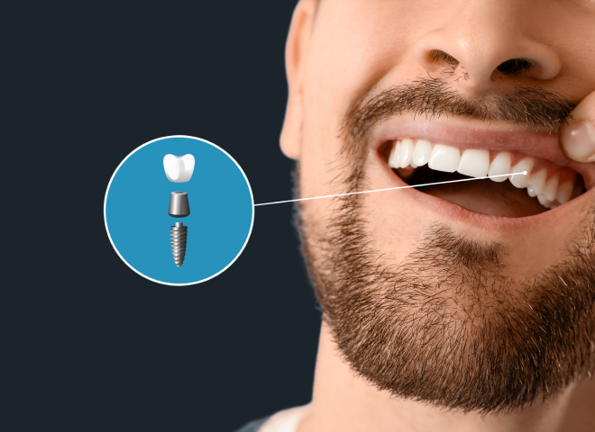 Illustration d'un implant dentaire pour un patient du cabinet à Genève