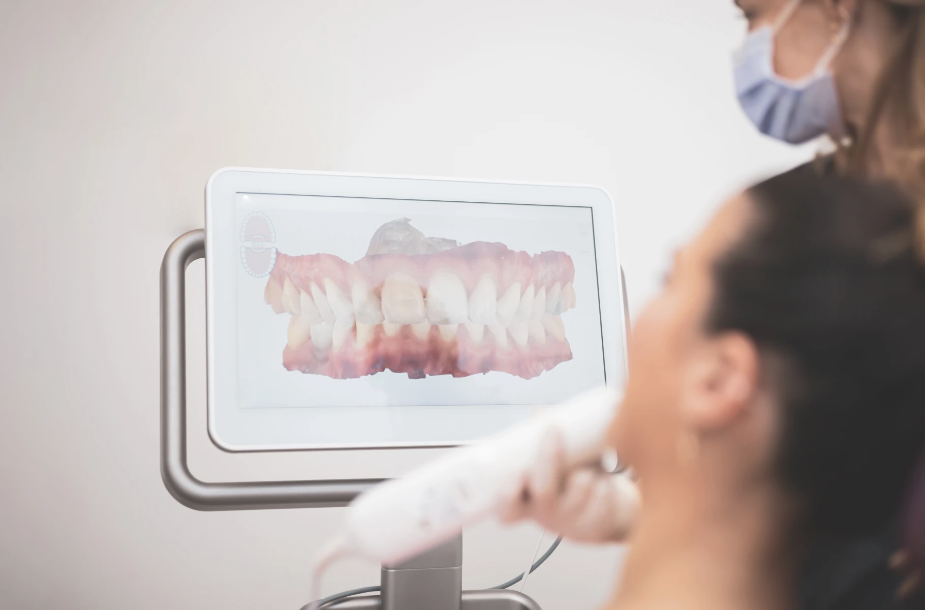 Empreinte numérique de la dentition réalisée par scanner intra-oral